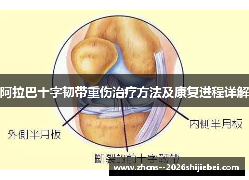 阿拉巴十字韧带重伤治疗方法及康复进程详解